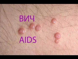 Симптомы ВИЧ